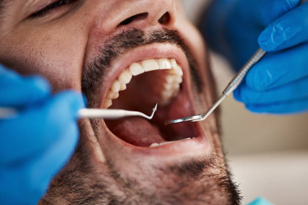 Best Emergency Gum Treatment in Milpitas, CA