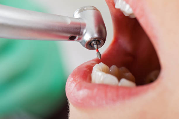 Best Emergency Treatment for Dental Infections or Abscesses in Milpitas, CA